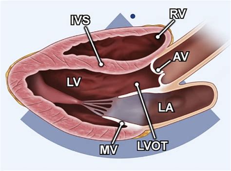 plax echocardiogram